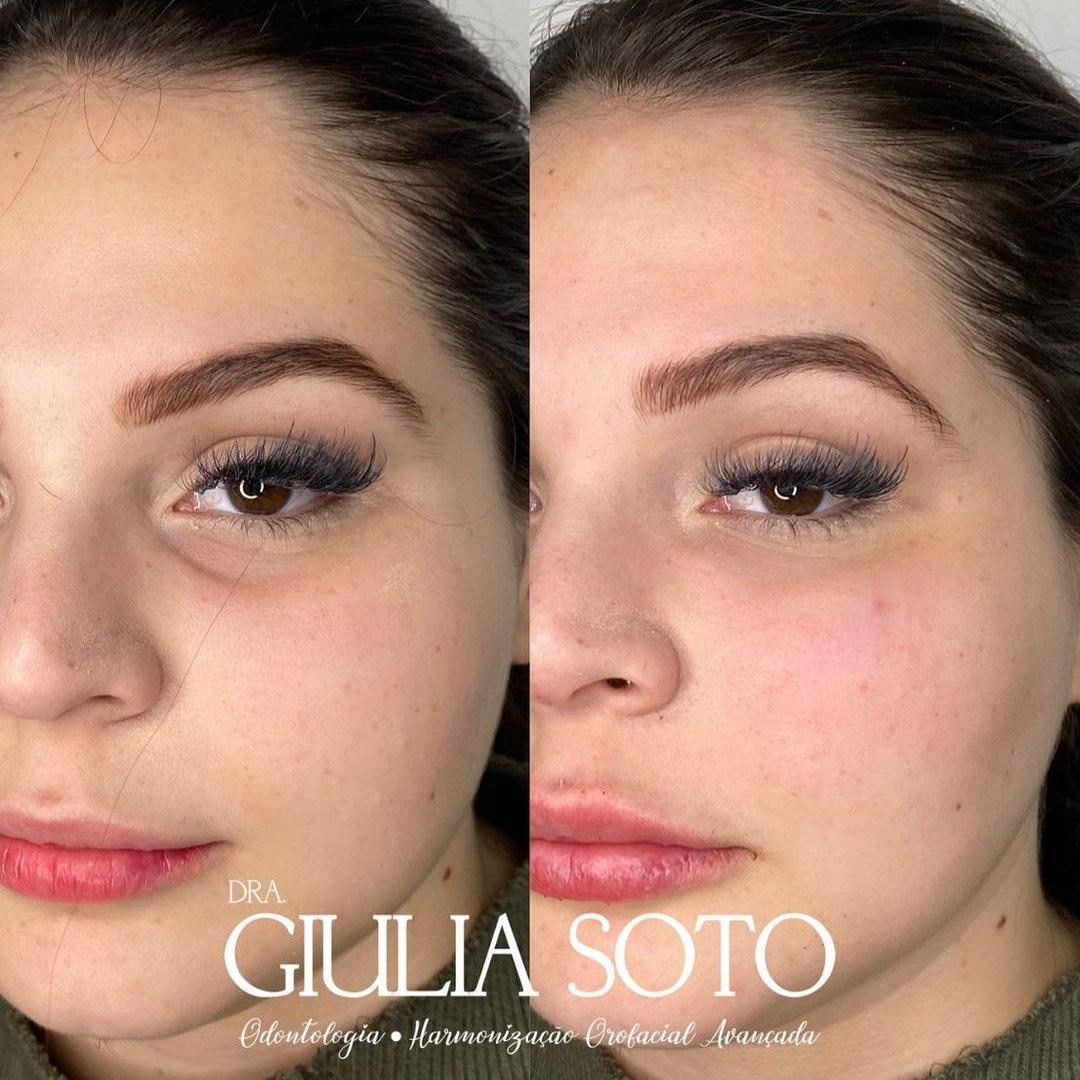 Preenchimento de Olheirasl Dra. Giulia Soto